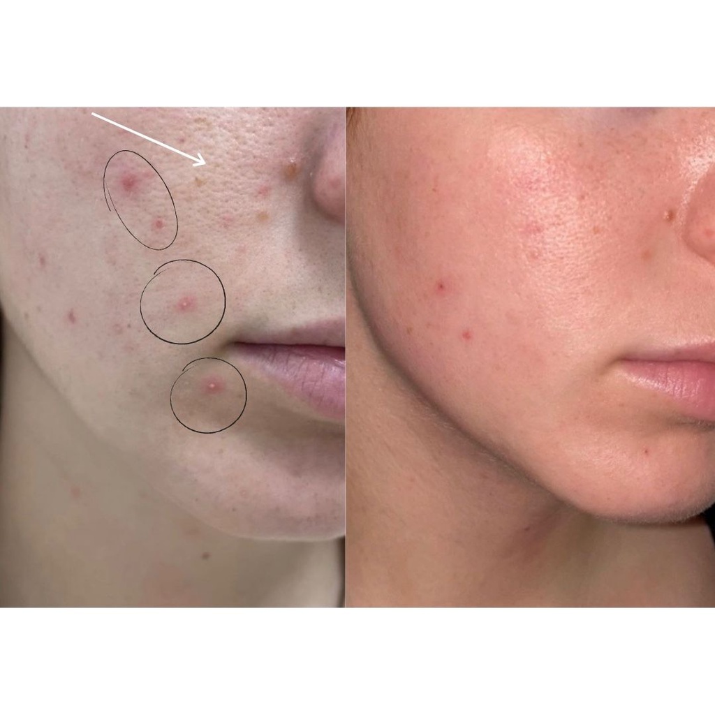 Clear - acné treatament (sérum 30ml.)